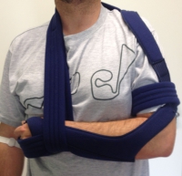 Proximaler Oberarmbruch2